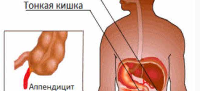 С какой стороны аппендицит находится и как проявляется его воспаление?