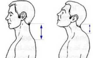 Гиперлордоз шейного отдела позвоночника
