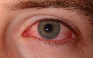 Заболевание синдром сухого глаза: симптомы и причины. Как вовремя распознать и не усугубить ситуацию?