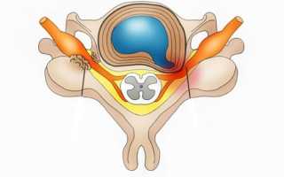Что такое фораминальная грыжа?
