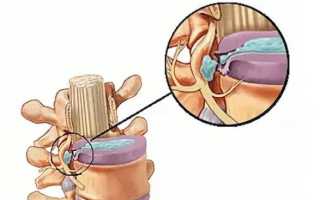 Секвестрированная грыжа позвоночника