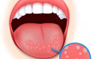 Заболевания слизистой оболочки полости рта и языка (СОПР)