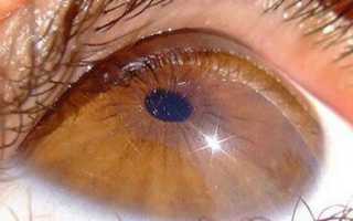 Лечение отслойки сетчатки глаза: возможные методы и прогнозы