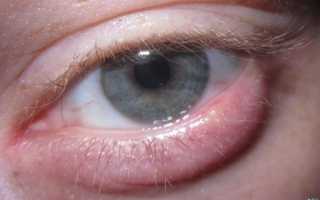 Быстрое и эффективное лечение ячменя на глазу медикаментами (мазь, капли и другие препараты)