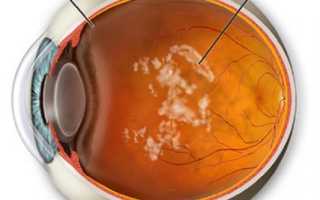 Лечение деструкции стекловидного тела глаза: поможет ли народная медицина?