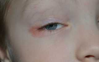 Почему у ребенка покраснел уголок глаза? С чем это может быть связано?