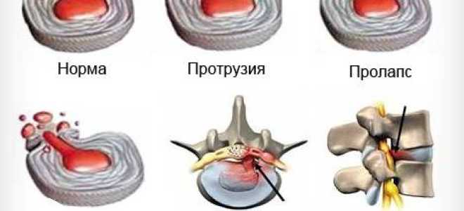 Чем отличается протрузия от грыжи межпозвонковых дисков