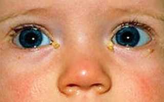 Что делать, если гноятся глаза у ребенка? Почему развивается недуг и чем его лечить дома?