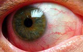 Что такое увеит? Лечение заболевания глаза народными средствами и медикаментозными препаратами