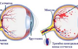 Что это за заболевание — тромбоз центральной вены сетчатки глаза и как его лечить?