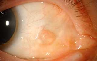 В чем опасность кисты конъюнктивы глаза? Эффективное лечение патологии
