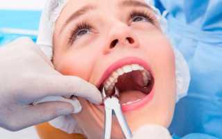 Воспаление надкостницы после удаления зуба