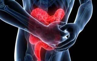 Рак тонкого кишечника: первые признаки и симптомы, классификация видов