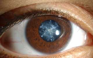 Что такое катаракта: симптомы, причины возникновения, признаки на ранних стадиях