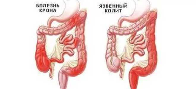 Свищ прямой кишки: причины, симптомы, как лечить свищ прямой кишки