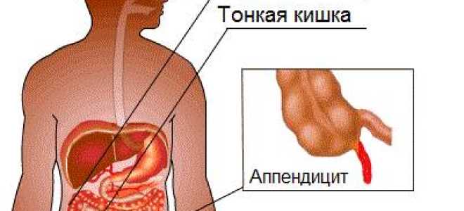 Как вырезают аппендицит? Особенности послеоперационного периода