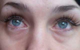 Почему глаза красные и слезятся и что с этим делать — причины и лечение симптома