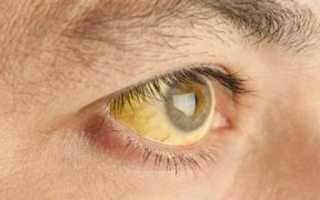 Почему желтеют белки глаз у взрослых: причины и лечение