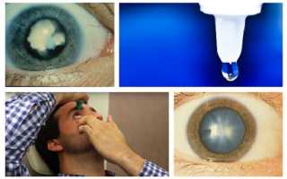 Какие глазные капли лучше и эффективнее от катаракты?