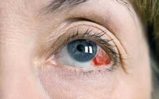 Что делать, если лопнул капилляр в глазу? Причины и последствия симптома?