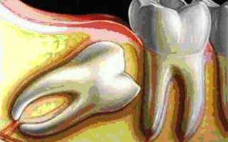 Перикоронарит — заболевания зубов влияют на пищеварение