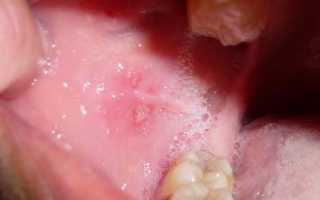 Как использовать Фурацилин для полоскания рта
