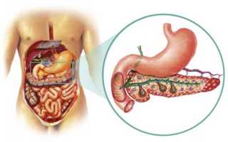 Как проявляется и лечится панкреонекроз поджелудочной железы?