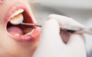 Что делать, если после удаления зуба опухла щека