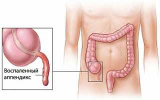 Как проходит и сколько длится операция на аппендицит