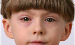Почему у ребенка может возникать отек глаз? Важно выбрать правильное лечение исходя из причин