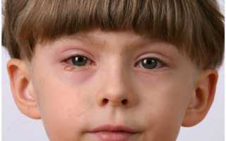 Почему у ребенка может возникать отек глаз? Важно выбрать правильное лечение исходя из причин