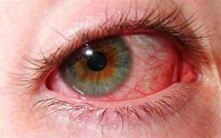 Симпатическая офтальмия — важно вовремя начать лечение, чтобы сохранить глаз