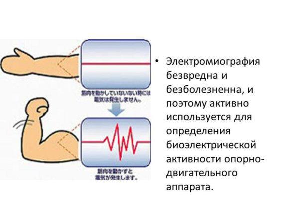 Электромиография