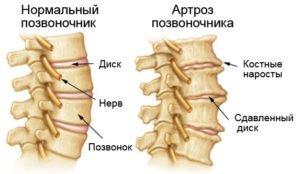 Позвоночный артроз
