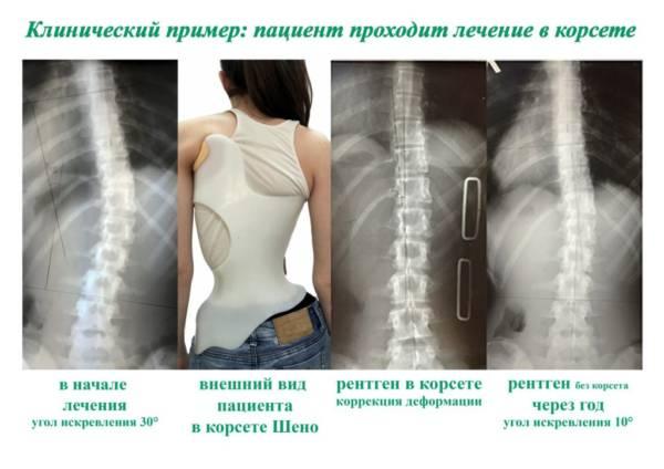 Лечение искривления позвоночника с помощью корсета Шено