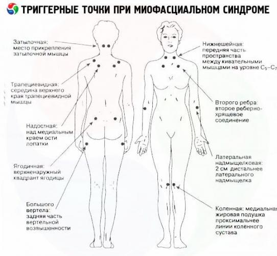 Миофасциальный синдром - триггерные точки