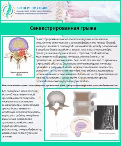 Секвестрированная грыжа