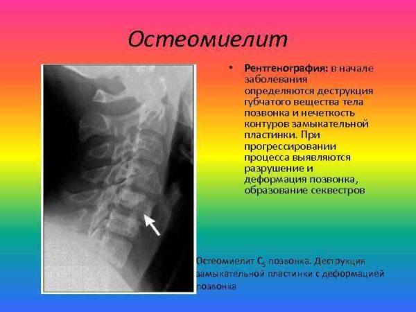 Остеомиелит позвоночника на рентгене