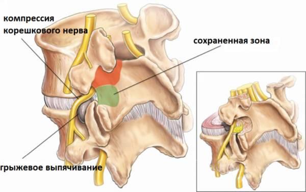 Наглядное изображение грыжи позвоночника