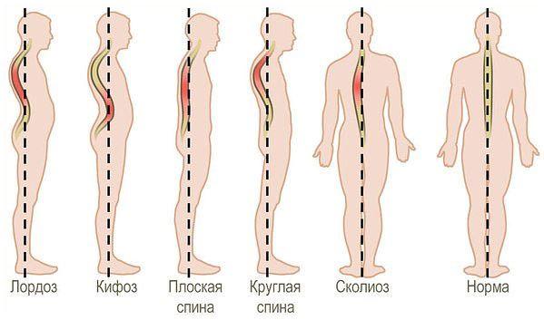 Виды искривлений с учетом деформации позвоночника
