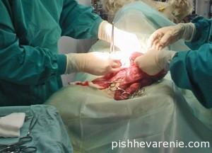 Лечение перитонита - хирургический метод