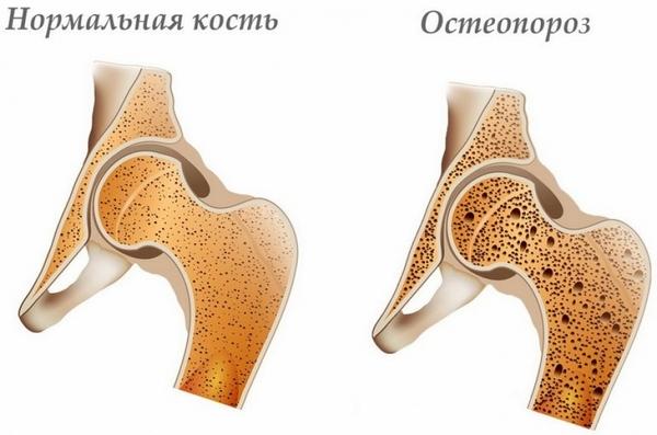 Остеопороз развивается постепенно и со временем может стать фактором риска для появления частых переломов