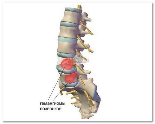 Гемангиолипома позвонка