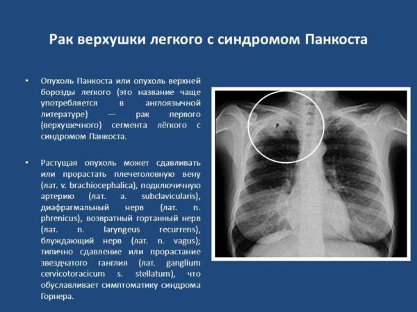 Рак верхушки легкого с синдромом Панкоста