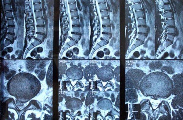 МРТ-снимок поясничного отдела позвоночника