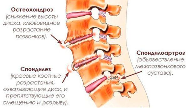 Отложение солей может являться одним из проявлений хронических патологий позвоночника - остеохондроза, спондилеза или спондилоартроза