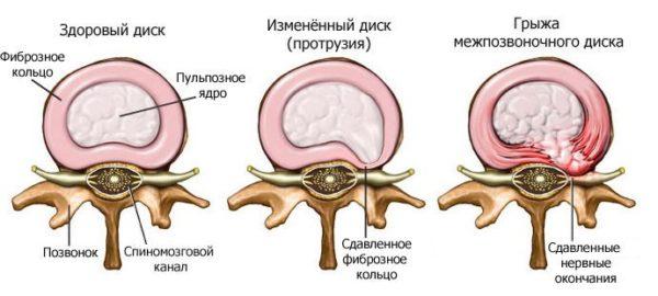 Грыжа межпозвоночного диска