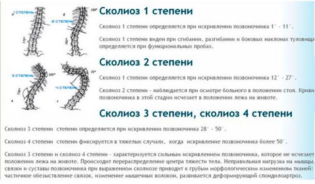 Степени искривления