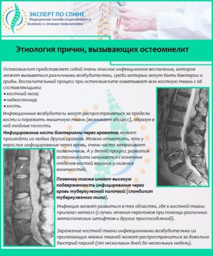 Этиология причин, вызывающих остеомиелит