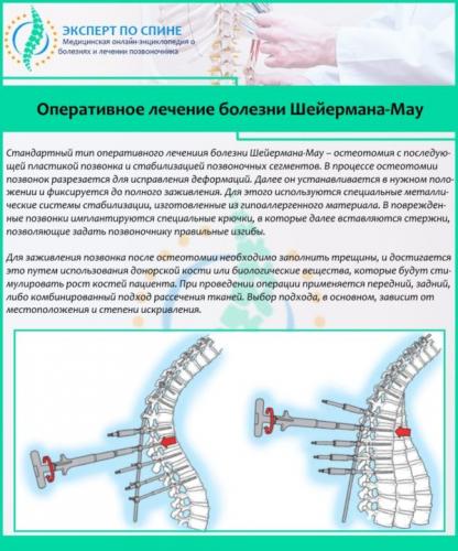 Оперативное лечение болезни Шейермана-Мау